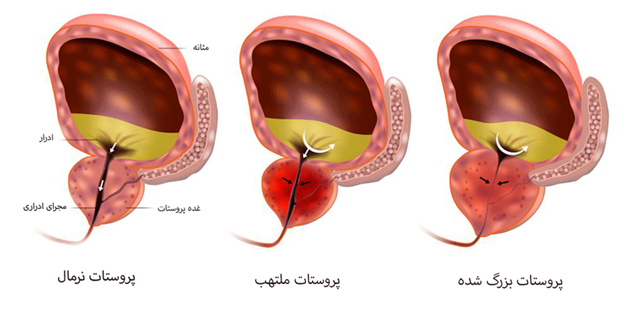 علائم پروستات چیست؟
